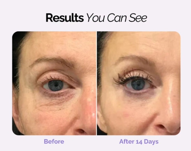 Ollo Eye - Dispositivo Anti-olheira